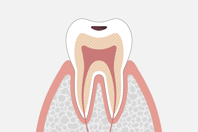 C1：エナメル質の虫歯